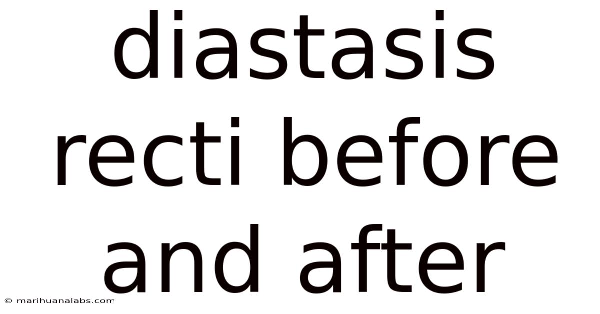 Diastasis Recti Before And After